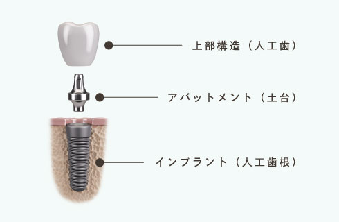 上部構造（人工歯）・アバットメント（土台）・インプラント（人工歯根）