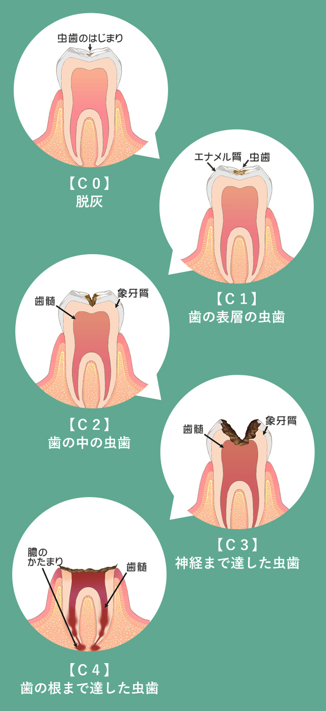 豊島区　虫歯の進行
