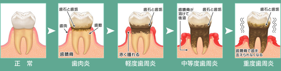 豊島区　歯周病の進行