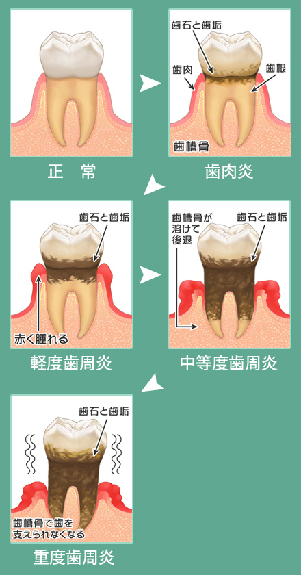 豊島区　歯周病の進行